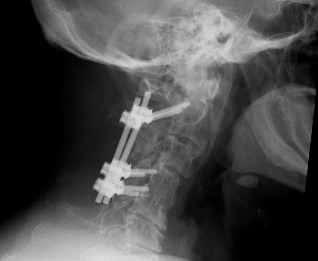 hangman-s-c2-fracture-the-bone-school